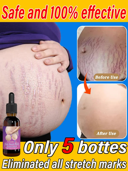 Body essential oil suitable for pregnant women, remove stretch marks, moisturize and soothe skin